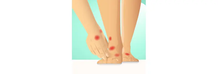 Hände und Füße mit Pyoderma Gangraenosum