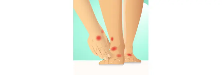 Hände und Füße mit Pyoderma Gangraenosum